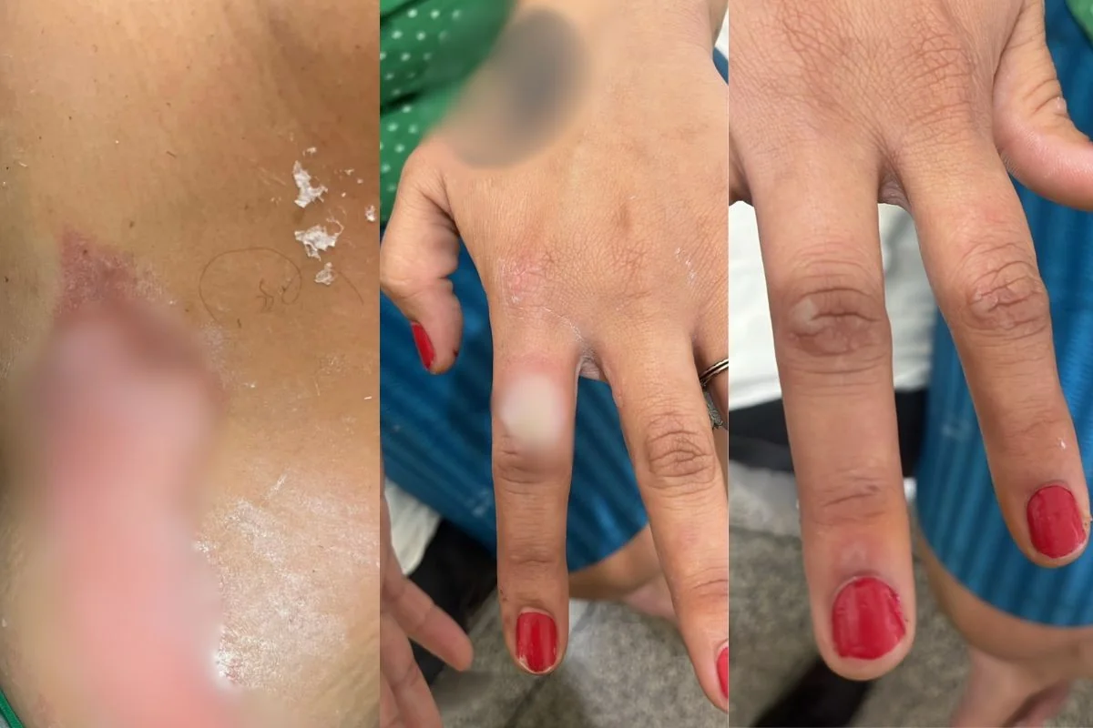 Preso suspeito de atear fogo na companheira por ela pintar as unhas de vermelho, no PR